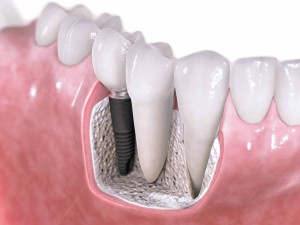 Implantes-dentales-con-cirugia-imoi